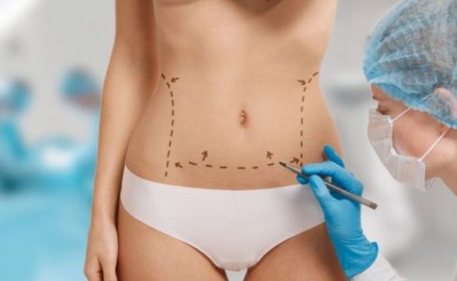 Imagen Abdominoplastia