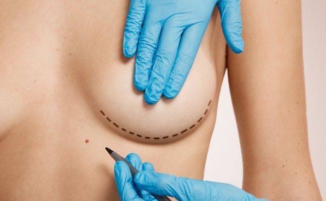 Imagen Mamoplastia de aumento sin protesis